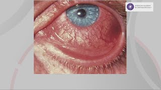 Is a new COVID variant causing more cases of pink eye?