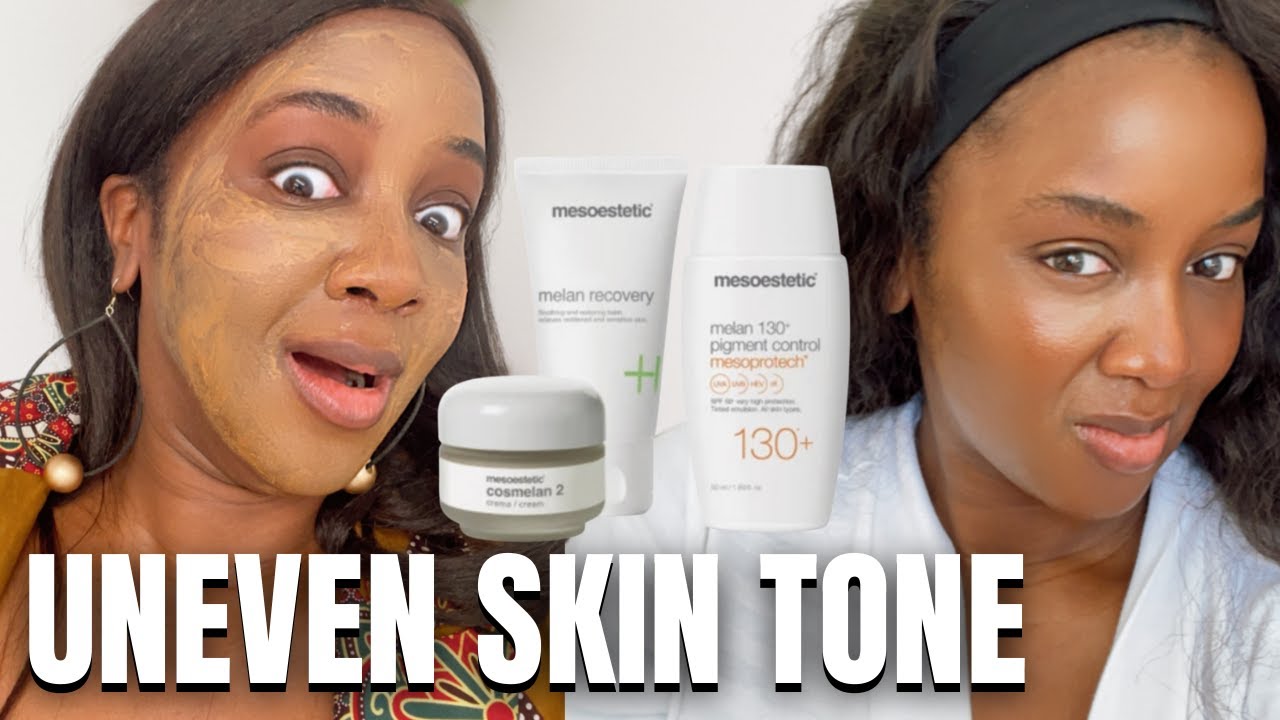 COSMELAN Chemical Peel for Hyperpigmentation (Black Skin) Diary Pt 1