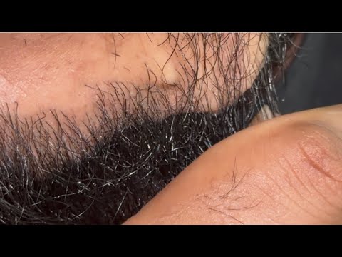 Hair barsha asmr beard massage 💆 relaxing | massage hair salon 💇 massage | ingrown hair satisfying
