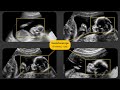 Expanding Ultrasound Access with AI | Google Health
