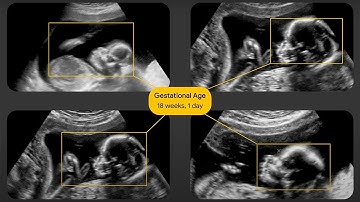 Expanding Ultrasound Access with AI | Google for Health