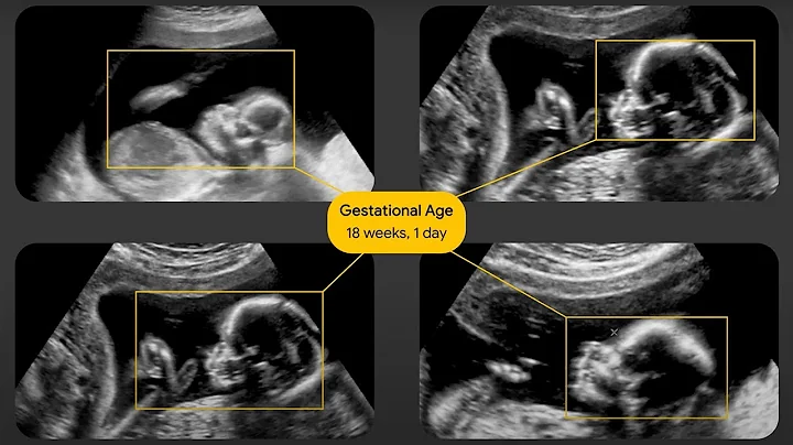 Expanding Ultrasound Access with AI | Google for Health
