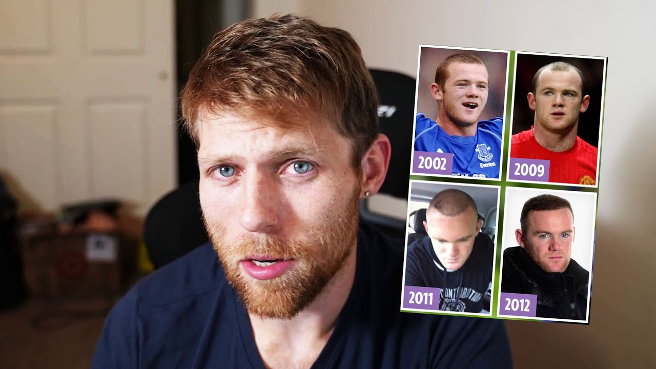 Wayne Rooney's Hair Loss Is Back..