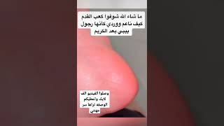 خلطه للتشققات القدمين