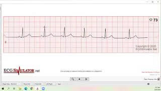 ECG Made Easy for Arabs 2020 تحليل تخطيط القلب للاخصائيين الصحيين