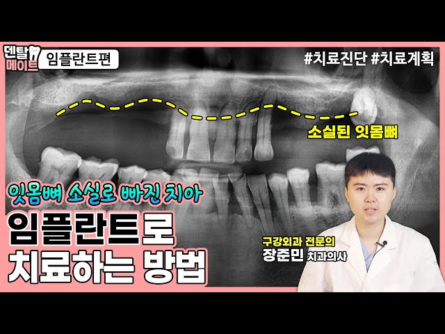 치아 대부분이 상실되었을 때 임플란트로 치료하는 방법 [만성치주염, 임플란트 케이스, 치료진단, 치료과정, 치료계획] | 덴탈메이트