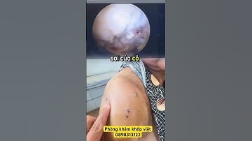 Kết quả sau mổ nội sôi rách gân chóp xoay cho người lớn tuổi #rachganchopxoay #dauvai #rachgan