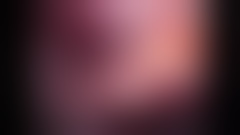 My Favourite Segmentectomy. Robotic S2+S6 Bisegmentectomy for an Interfissural Right Sided Tumour