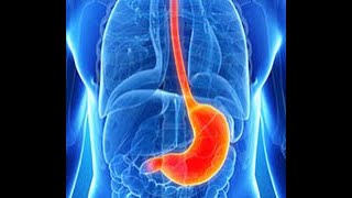 Gastritis,What is gastritis?  What are the causes of gastritis?