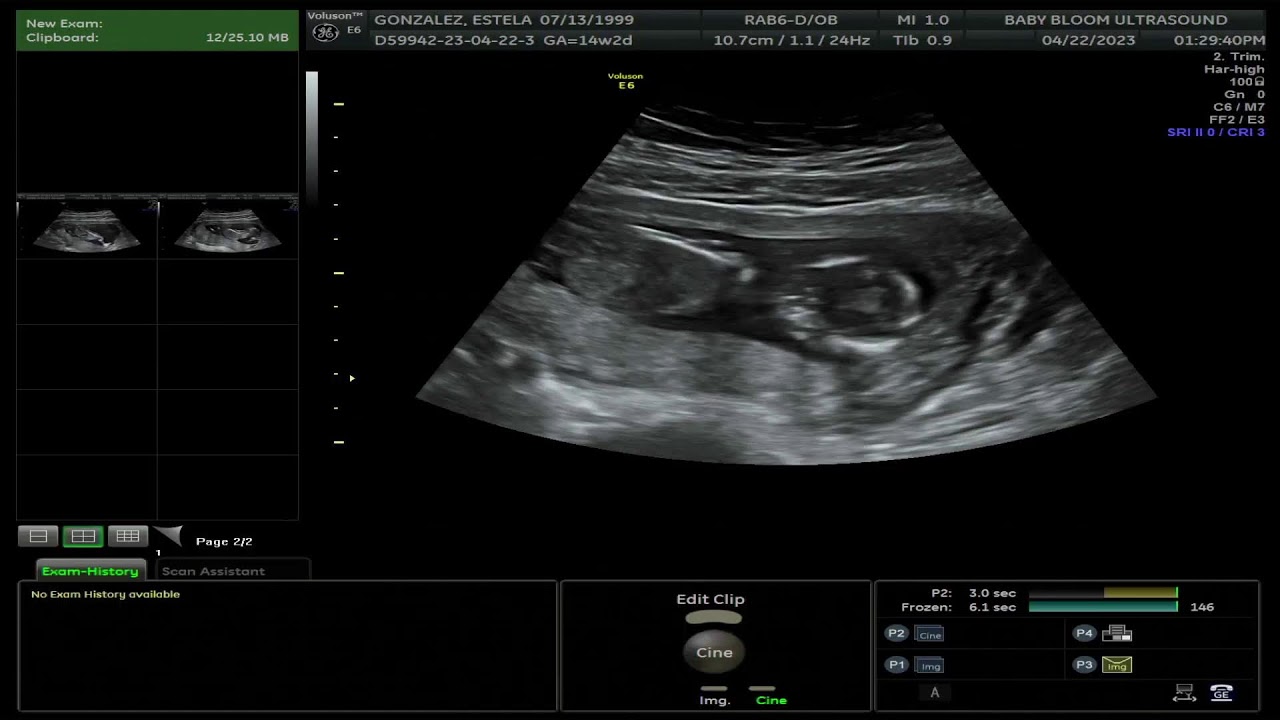 Baby bloom ultrasound live stream youtube
