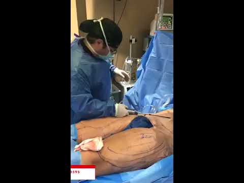 🥼dr-jeneby-live-from-the-or:-liposuction-+-bbl-🍑-|-plastic-surgery-in-san-antonio-by-dr-jeneby