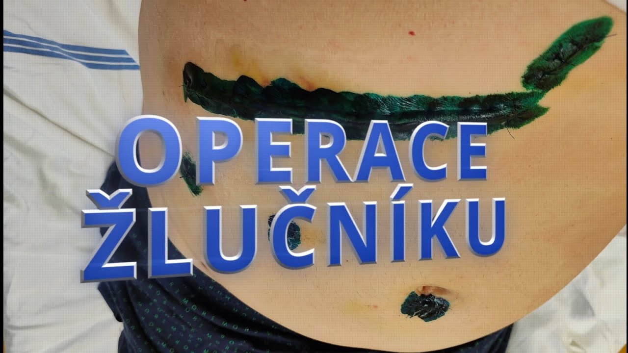 OPERACE ŽLUČNÍKU: MUSÍM NA OPERACI! 🏥 Odstranění ŽLUČNÍKU – Co vás čeká ...