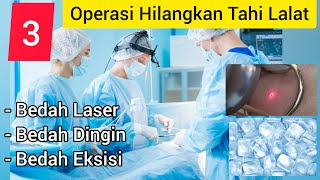 Cara Menghilangkan Tahi Lalat Hidup Dengan Operasi Laser, Bedah Dingin, & Bedah Sayatan