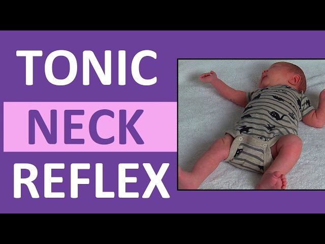Tonic Neck Reflex in Infant Newborn | Pediatric Nursing Newborn Assessment class=