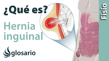 ¿Cómo afecta la hernia inguinal al intestino?