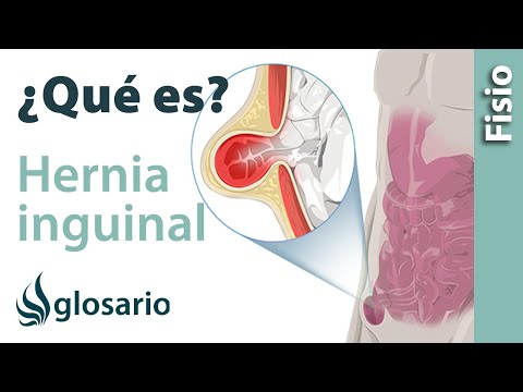 Vídeo: Hernia Inguinal: Causas, Síntomas Y Diagnóstico