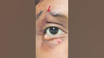 Rx of Cicatricial ectropion of lower eyelid (Before and after)
