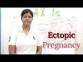 ectopic pregnancy lecture in hindi | definition | types | etiology or causes | signs and symptoms