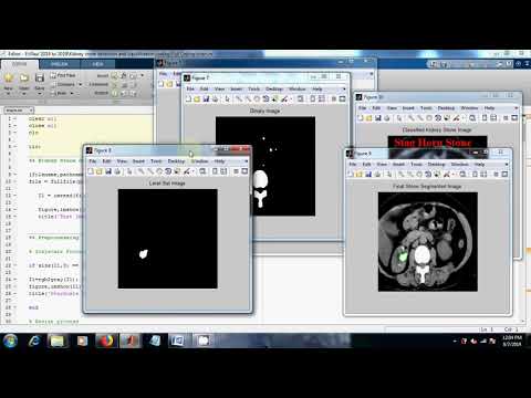 Kidney Stone Detection and Classification | Medical Image Processing | MATLAB
