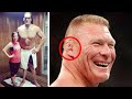 10 Wrestlers Who Suffered With Illnesses & Body Deformities (WWE etc)