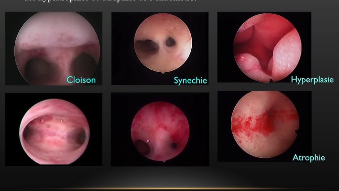 Cure de synechie au cabinet par hysteroscopie haute définition ,biopsie endomètre - YouTube