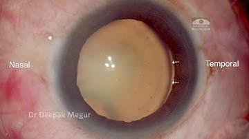 Traumatic Subluxated Cataract- Phaco, CTR  with IOL trap technique- Dr Deepak Megur