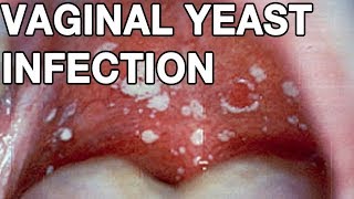 Pussy Talk: How To Cure/Prevent BV And Yeast Infections Naturally