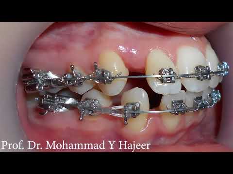 حالة بروز سني مضاعف عولجت بقلع 4 ضواحك والإرجاع إلى الوراء الدكتور محمد يونس حجير