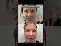CO2 Laser Resurfacing