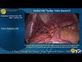 Laparoscopic Longitudinal Pancreaticojejunostomy (Puestow)...