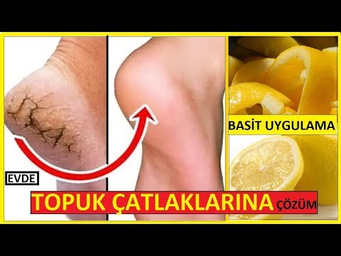 topuk çatlaklari nasil gi̇deri̇li̇r? kesi̇n çözüm- li̇mon kabuğu-ayak bakimi-güzelli̇k bakim