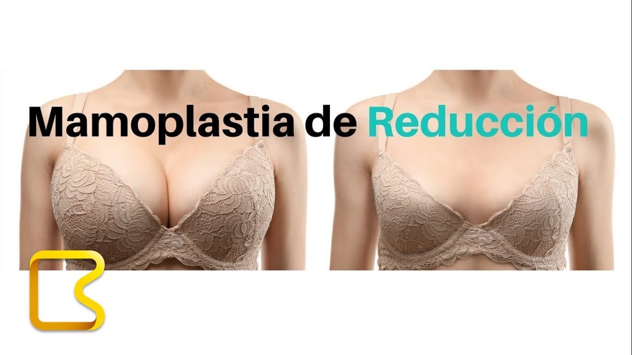 ¿ Qué es una mamoplastia de reducción ? YouTube