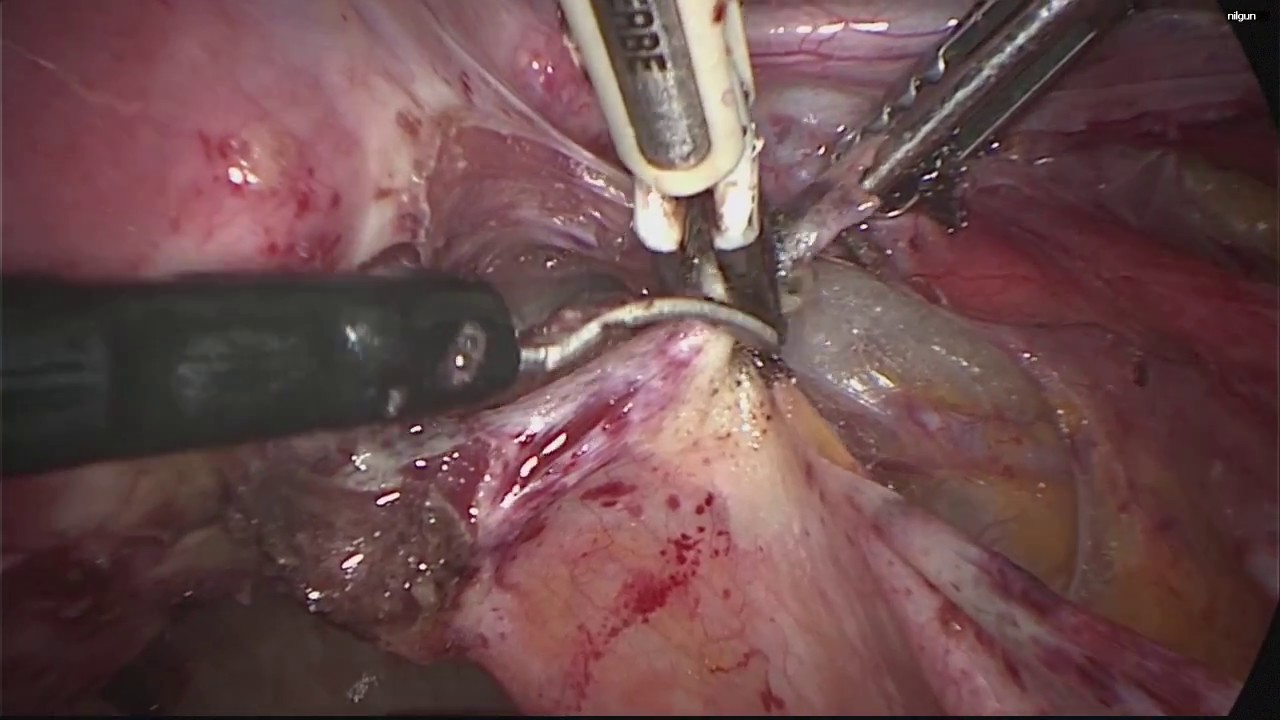 Laparoscopic Deep Endometriosis Surgery