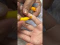 loose motion treatment #healthtips #accupressurepoints #accupressure #colortherapy