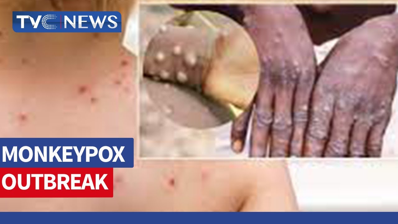 Monkeypox: Experts Believe Risks Of Spread Moderate Despite W.H.O Alert
