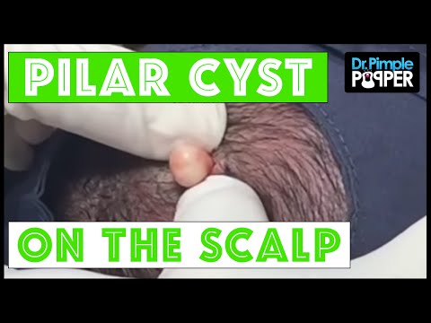 A Perfect Pilar Cyst Pop: Dr Pimple Popper & Buzzfeed!