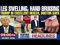 Leg Swelling, Hand Bruising | Trump In Excellent Health, Doctor Says | 9 PM News Headlines