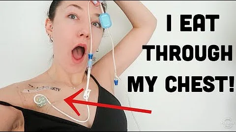 I EAT THROUGH MY CHEST: My TPN Set Up! | Amy Lee F...