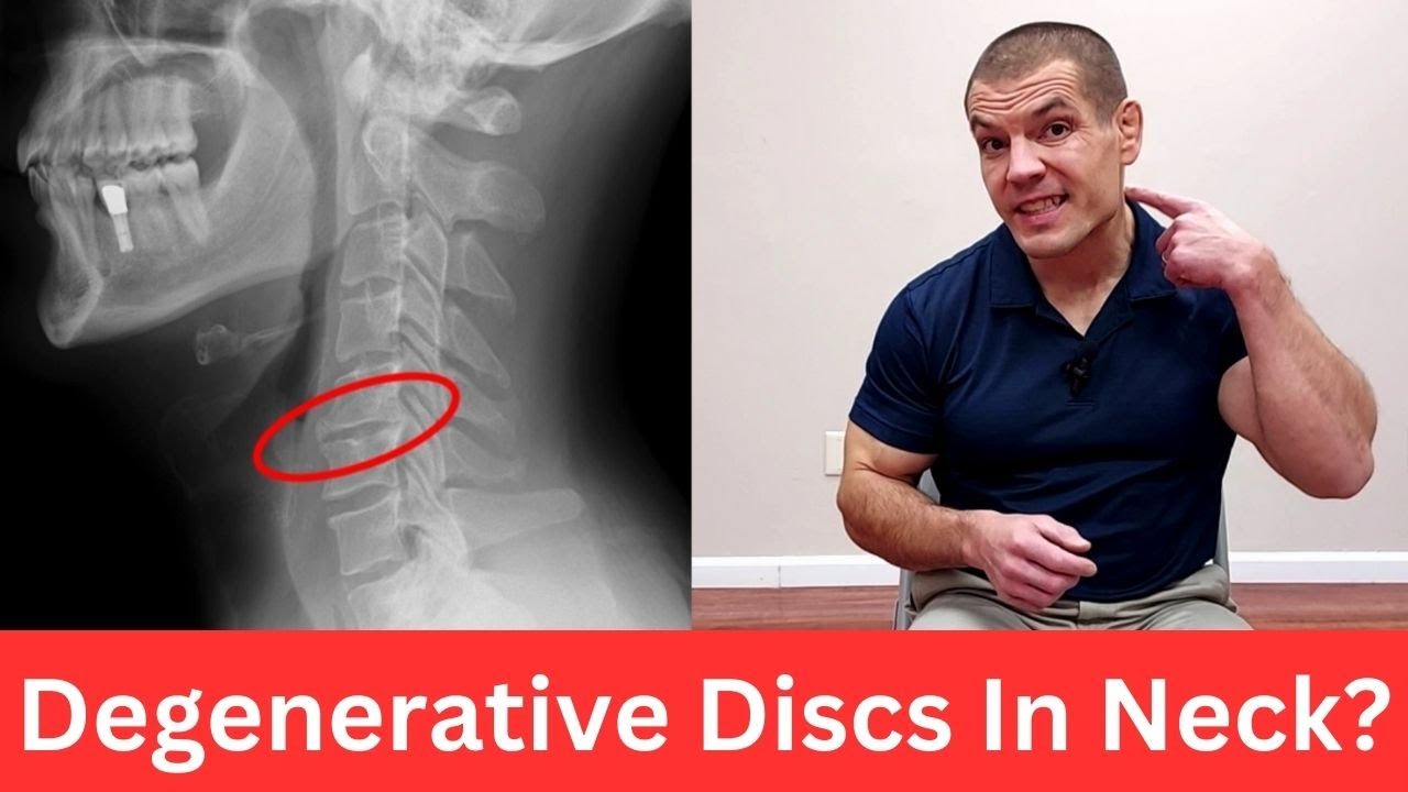 3 Exercises For Cervical Degenerative Disc Disease Relieve Neck Pain 3-exercises-for-cervical-degenerative-disc-disease-relieve-neck-pain