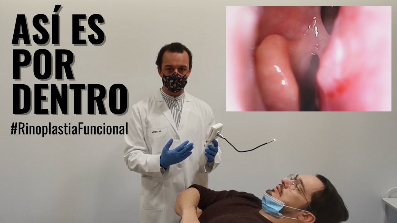 Rinoplastia Funcional para respirar bien, Así se hace una Rinoscopia 