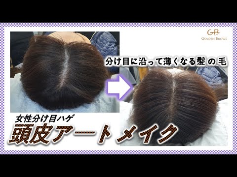 女性薄毛 分け目から頭頂部まで頭皮アートメイク施術の全て Youtube