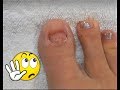 No TOENAILS / Make Some / Acrylic  Glitter Toesnails | Using Dual Forms