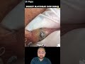 Biggest Blackheads Ever Seen | Blackheads Removal 😱