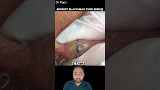 Biggest Blackheads Ever Seen | Blackheads Removal 😱