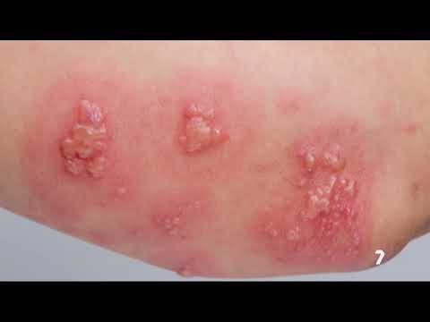 Alertan del incremento de hospitalizaciones por herpes z&oacute;ster en toda Espa&ntilde;a