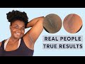 Laser Hair Removal | Real People, True Results