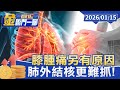 肺結核的健康議題