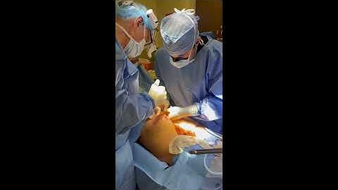 Butt Augmentation | Orange County Plastic Surgery #plasticsurgeon #plasticsurgeryresults