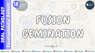 Fusion | Gemination | How to differentiate between fusion and gemination | Dr Paridhi Agrawal
