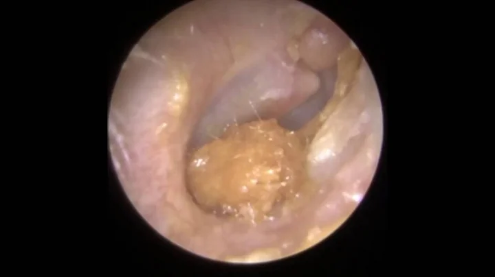 Ear Wax Removal Leicester - Mr Neel Raithatha (The...